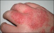 Typical, mild dermatitis