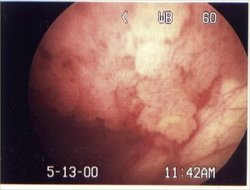 Bladder Cancer -- Biotechnology Encyclopedia