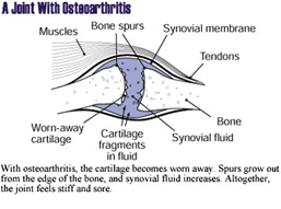 An illustration of a Joint with Osteoarthritis