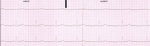 Electrocardiogram of a healthy man, 21 years old