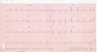 12-lead electrocardiogram (ECG) with ST-segment elevation in leads II, III and aVF, suggestive of an inferior acute myocardial infarction (AMI).